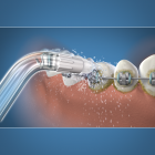 Waterpik Whitening Water Flosser Orthodontic Tip, WOD-2E